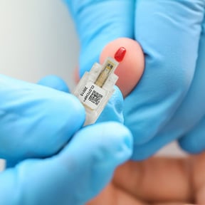 Collecting blood for clotting analysis with the Clot Chip Sensor